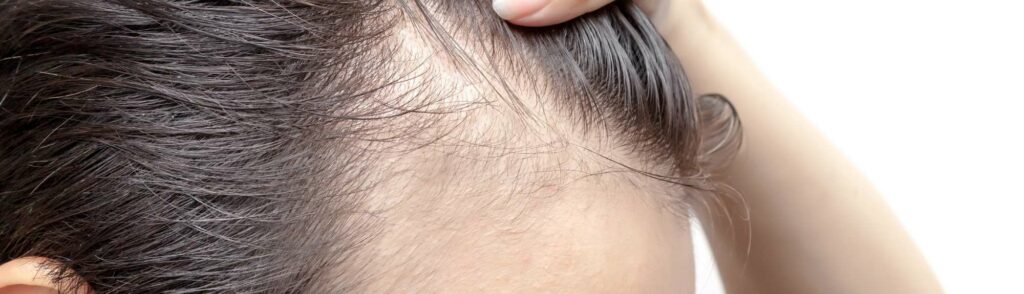 alopecia fibrosante