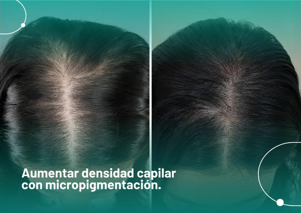 Aumentar densidad capilar con micropigmentación