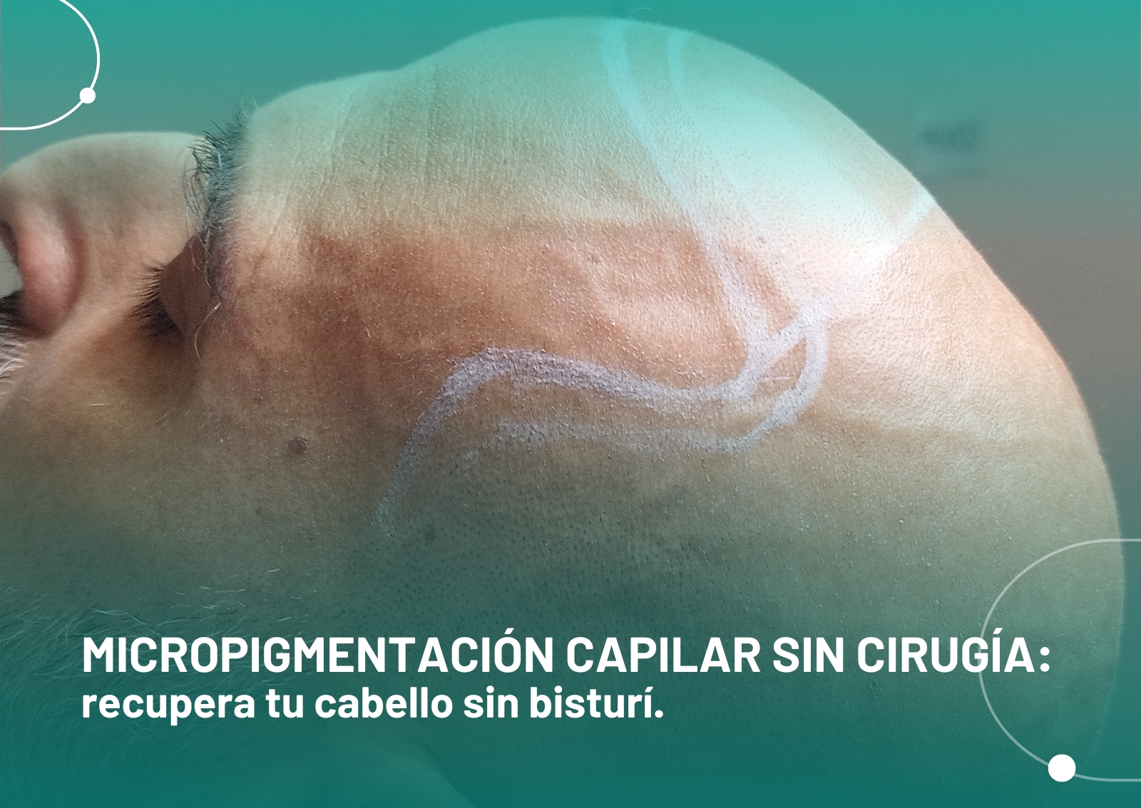 Micropigmentación capilar sin cirugía Valencia
