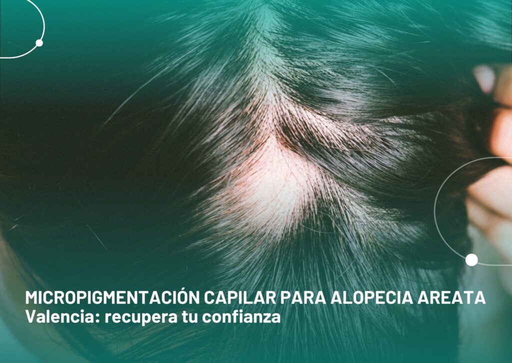 Micropigmentación capilar para alopecia areata