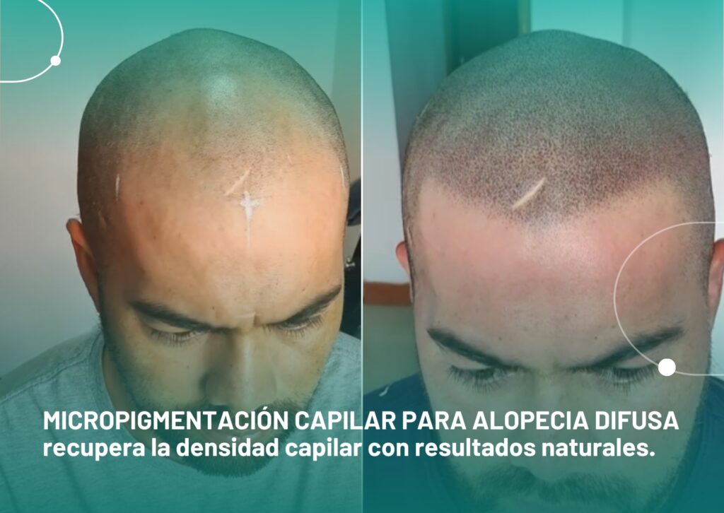Micropigmentacion-capilar-para-alopecia-difusa