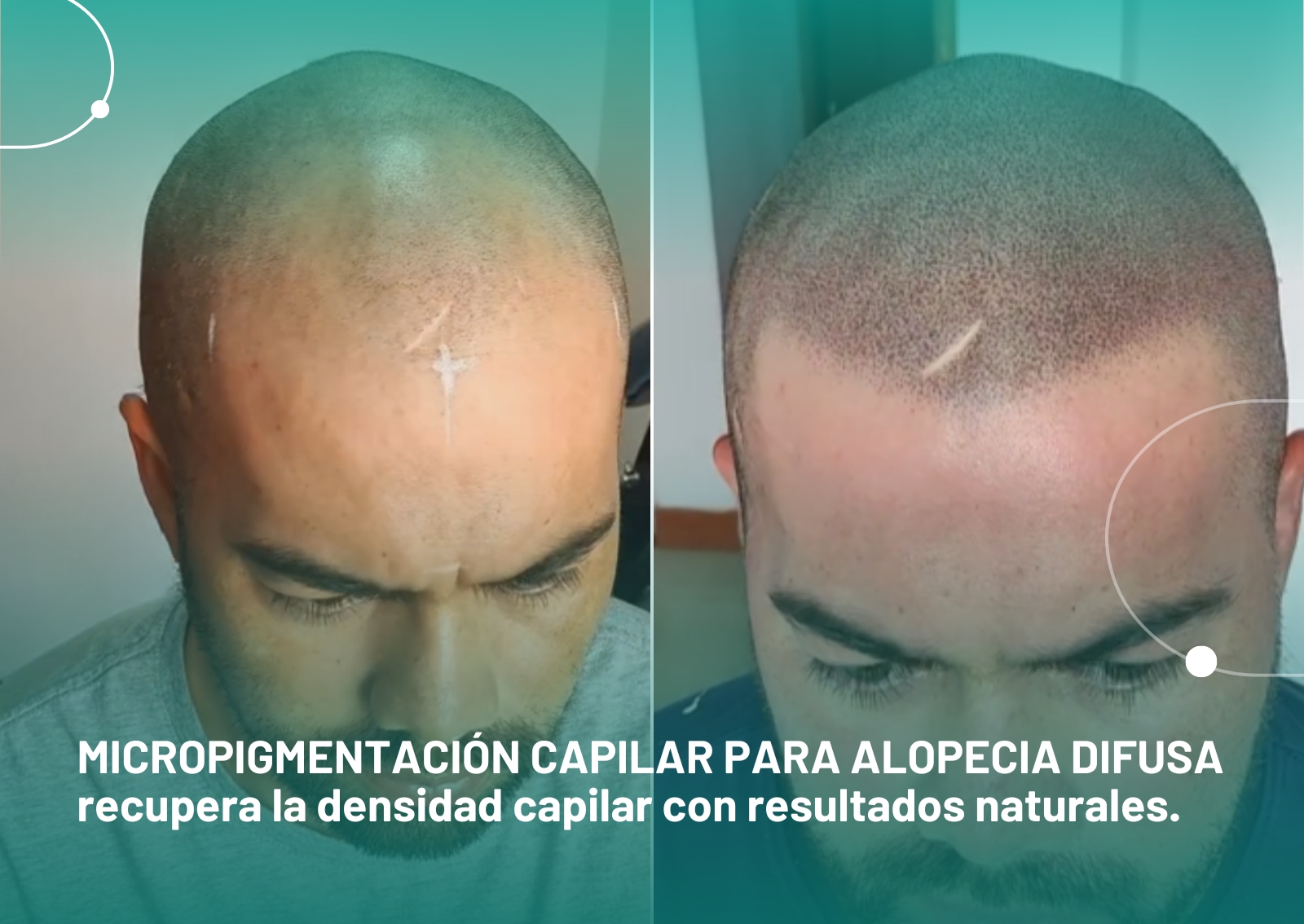 Micropigmentacion-capilar-para-alopecia-difusa